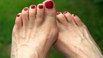 O que é joanete: pés femininos com unhas pintadas de vermelho.